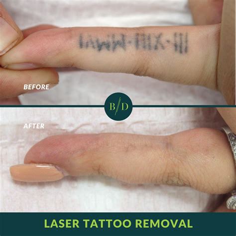 nude tattoo removal